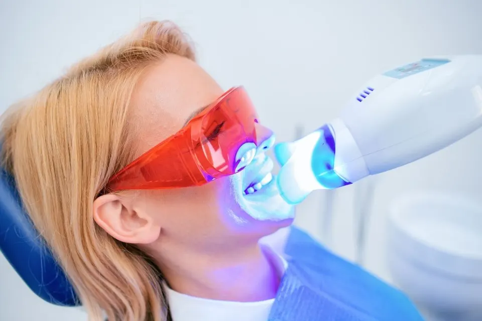 LED lámpás fogfehérítés a Hollán Dentnél – 1. kép